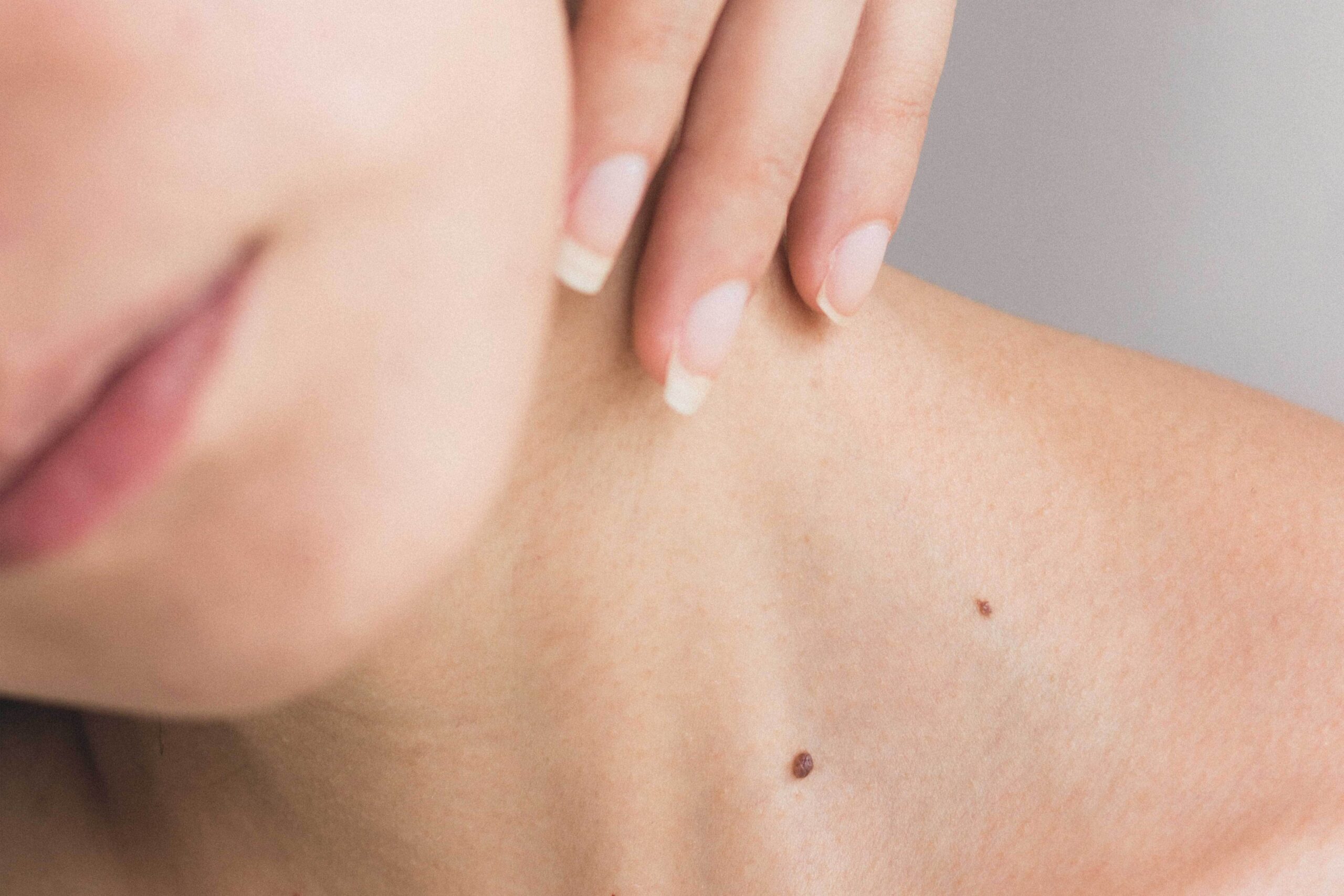 “I Have a New Mole”: Causes and When to See a Dermatologist